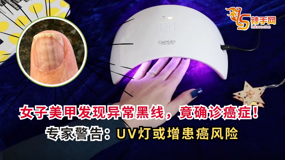 女子美甲发现异常黑线，竟确诊癌症！专家警告：UV灯或增患癌风险